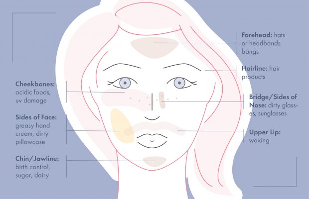 Renée Rouleau face mapping by location of acne diagram