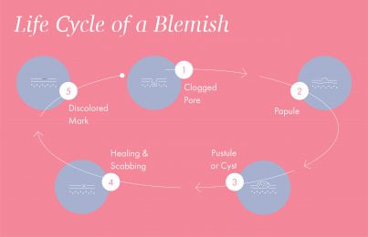 The Life Cycle of a Blemish: How to Spot-Treat a Pimple At Every Stage