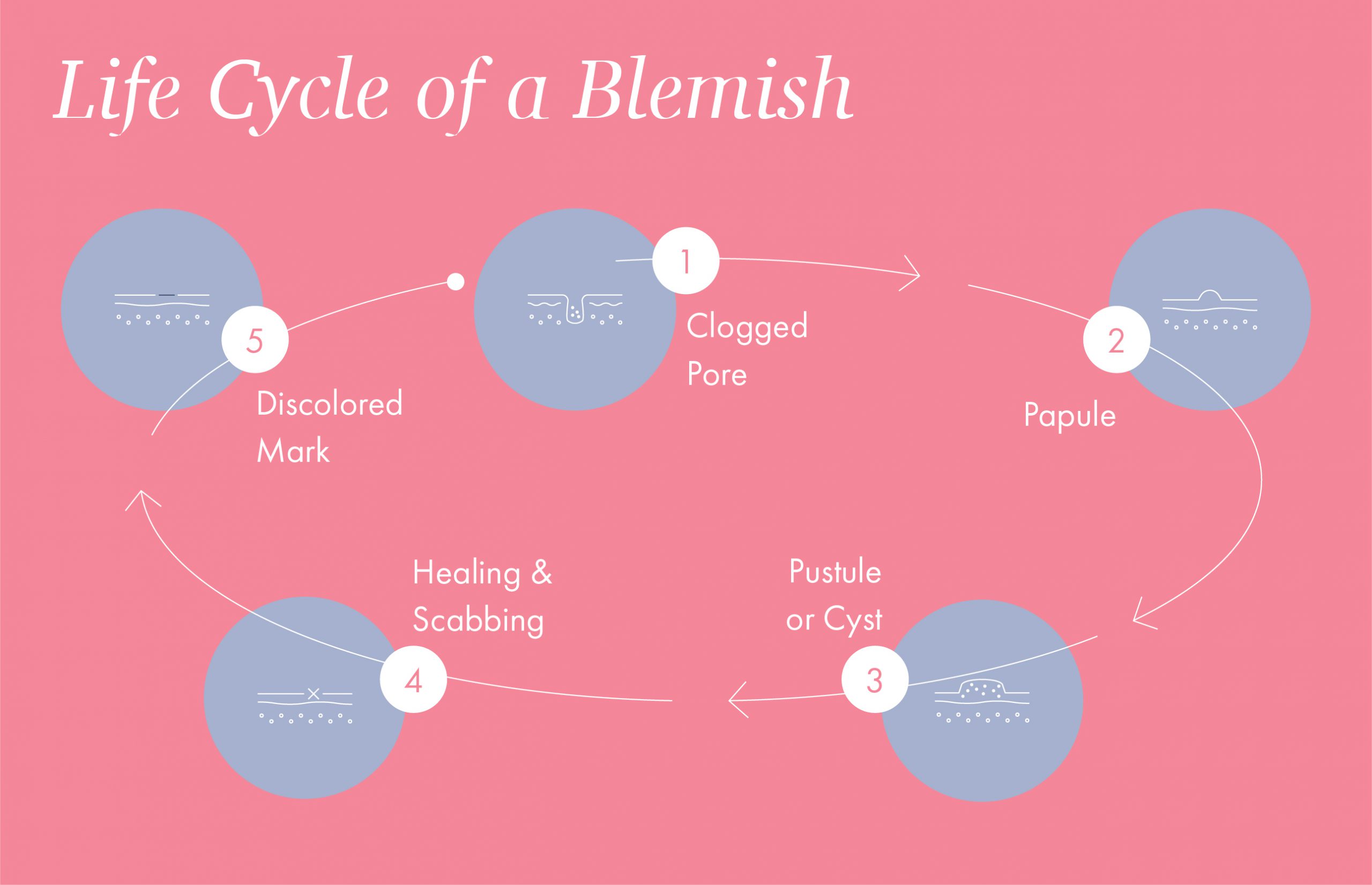 The 5 Levels of Pimples and Find out how to Spot-Deal with Every One