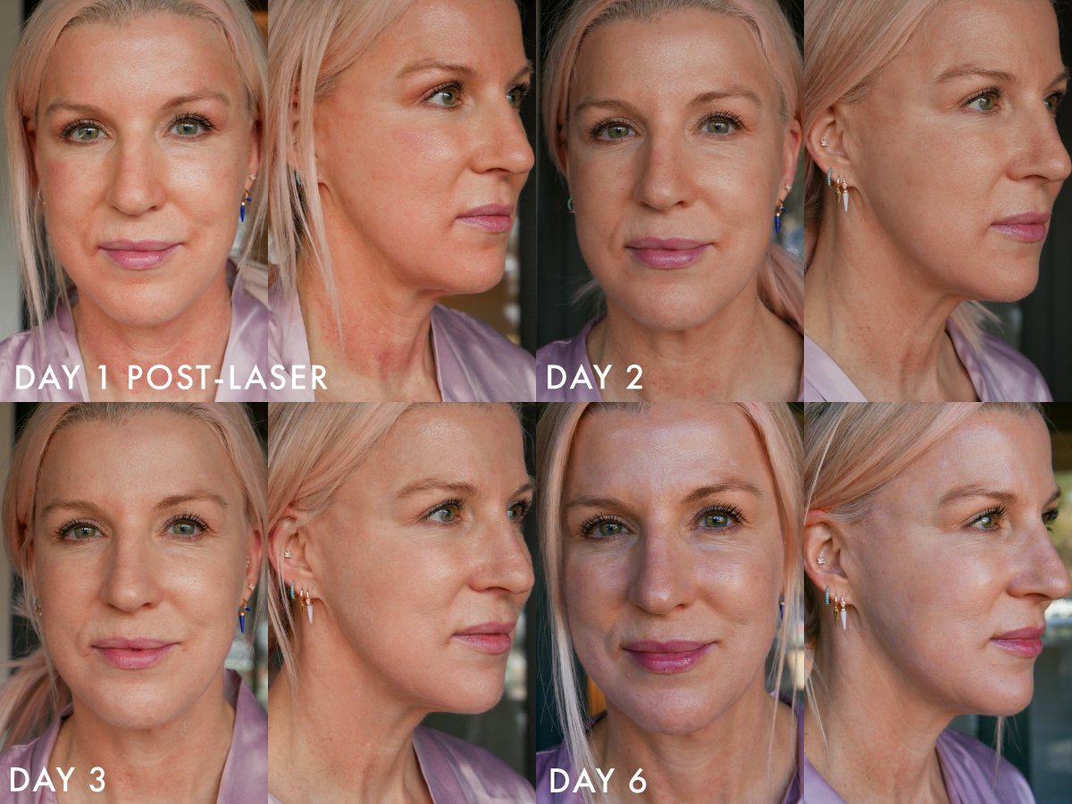 Renée Moxi Laser Treatment Experience: Before, After, & Tips