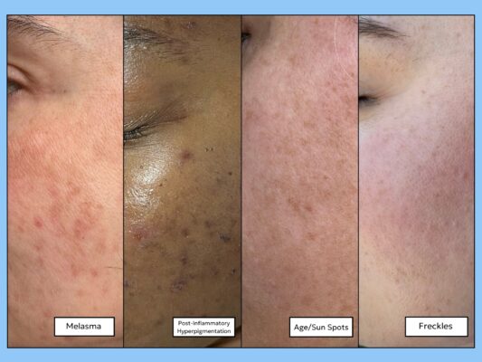 four types of skin discoloration