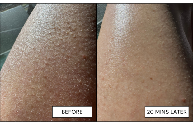 before and after leg facial