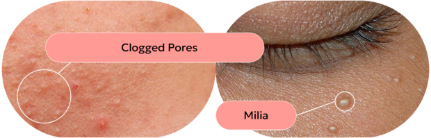 skin with clogged pores and skin with milia