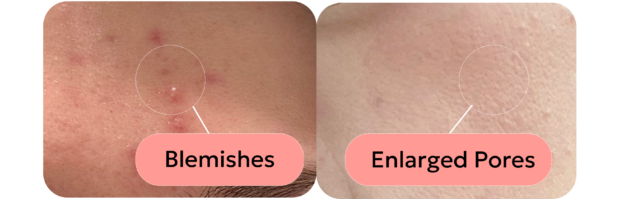 skin with blemishes and skin with enlarged pores