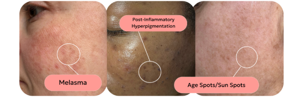 skin with different types of pigmentation