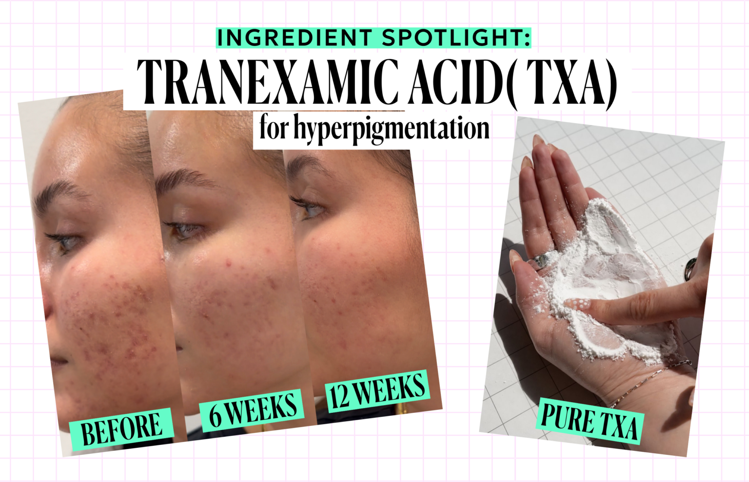 tranexamic acid before and after and ingredient