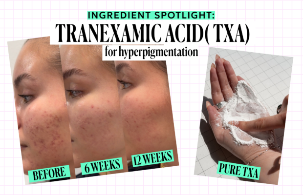 tranexamic acid before and after and ingredient