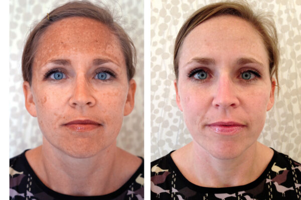 before and after hyperpigmentation treatments and home care