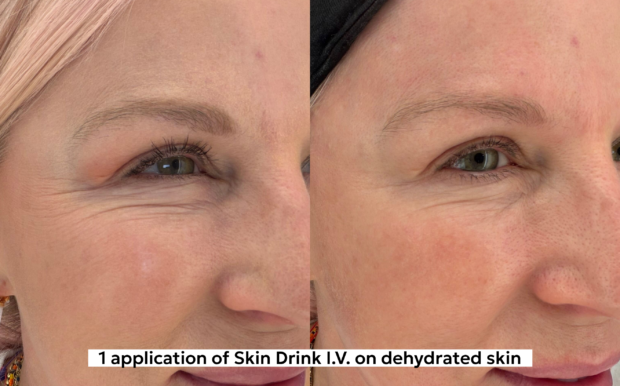 before and after using hydrating serum on dehydrated skin